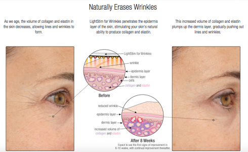 LightStim for wrinkles, before and after