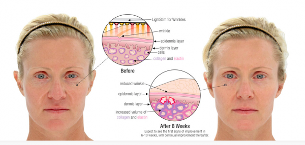 before and after, LightStim, wrinkle reduction